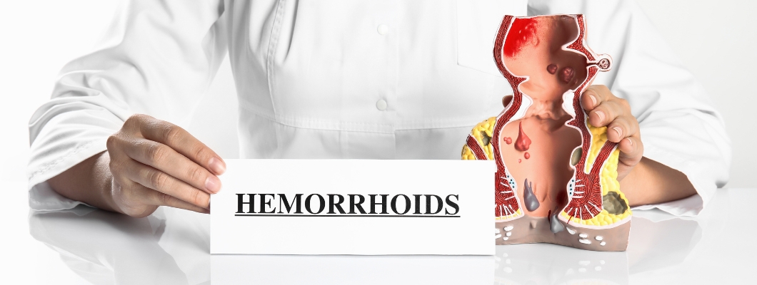 Que sont les Hemorroides externes?