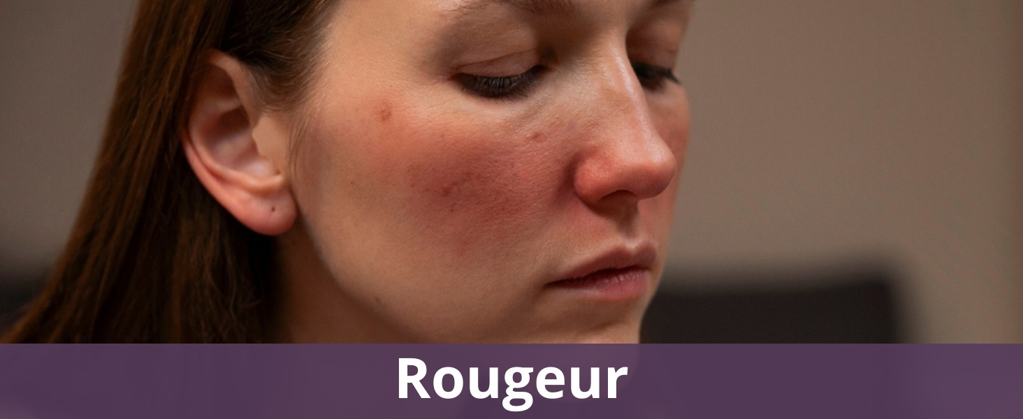 Rougeur