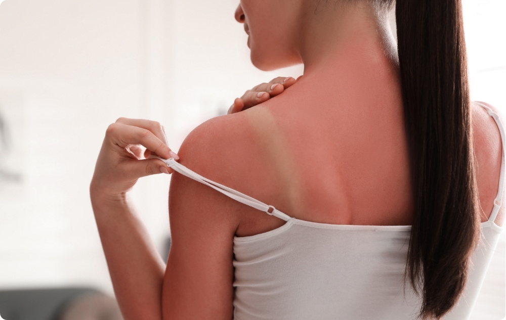 Comme huile après coup de soleil